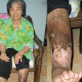 Hydrogen Rich Water For Cure Chronic Disease